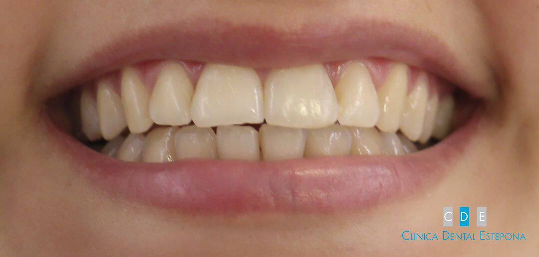 Antes — Blanqueamiento · Caso 1