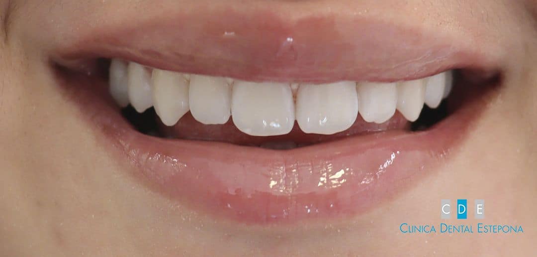 Después — Blanqueamiento · Caso 2